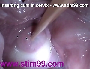 Outsert ball batter cum in cervix upon distension cum-hole reflector